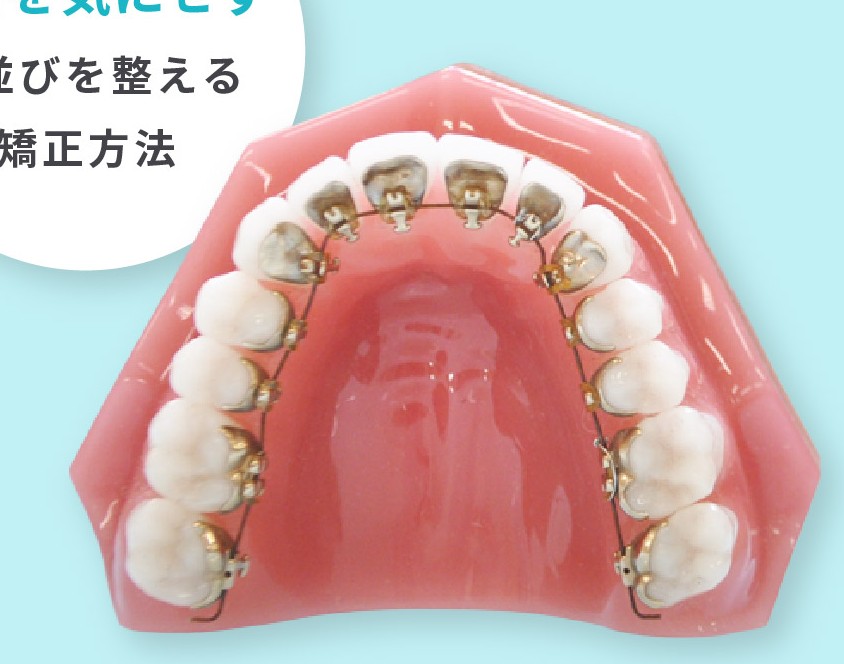 裏側矯正（リンガルブラケット）の装置