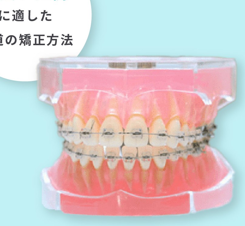ワイヤー矯正（マルチブラケット）の装置